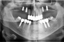 Situazione durante la riabilitazione con impiantologia ( astra tech sistema di impianti), 6 mesi doppo la estrazione dei denti