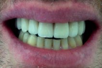 Situazione doppo il lavoro definitvamente fatto , 4 mesi doppo la terapia con impiantologia