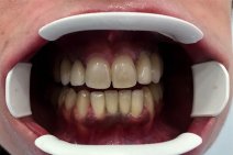 Il lavoro finito, doppo le estrazioni di denti da latte, e limatura del canino, sotto la luce dello studio