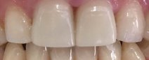 Paziente con veneers ( faccette estetiche) definitivamente cementate
