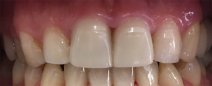 Paziente con veneers ( faccette estetiche) definitivamente cementate