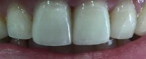 Paziente con veneers ( faccette estetiche) definitivamente cementate 